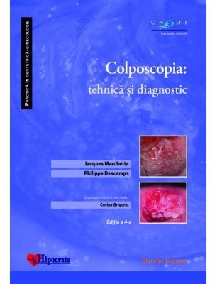 Colposcopia : tehnica si diagnostic
