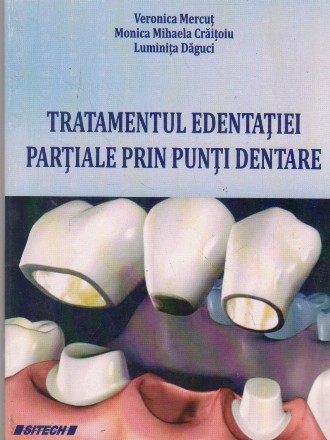 Tratamentul edentatiei partiale prin punti dentare
