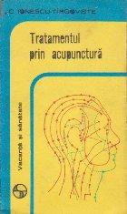 Tratamentul prin acupunctura